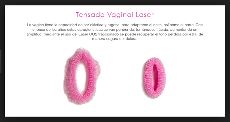 Tensado Vaginal Laser