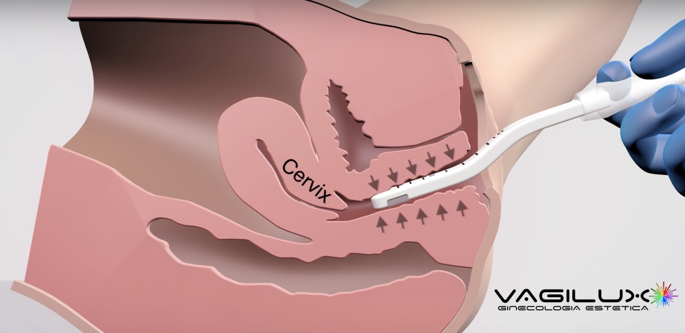 Contracción Inmediata